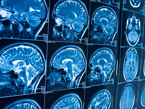 Catastrophic Injuries